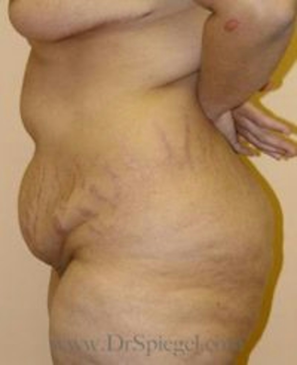 Tummy Tuck