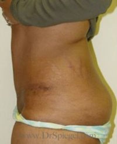 Tummy Tuck Before & After Gallery - Patient 156196 - Image 2