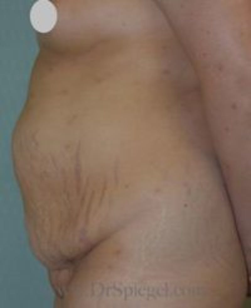 Mommy Makeover Before & After Gallery - Patient 204499 - Image 1