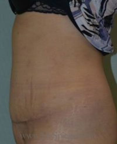 Tummy Tuck Before & After Gallery - Patient 265429 - Image 2