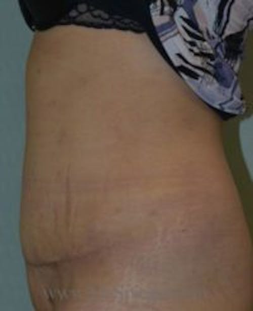 Mommy Makeover Before & After Gallery - Patient 204499 - Image 2
