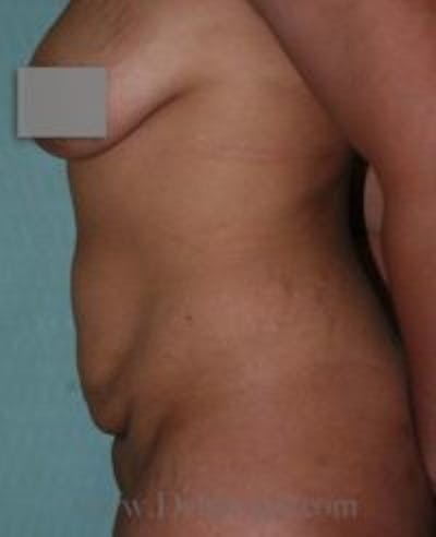 Tummy Tuck Before & After Gallery - Patient 206547 - Image 1