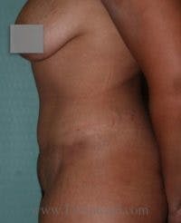 Mommy Makeover Before & After Gallery - Patient 367717 - Image 2