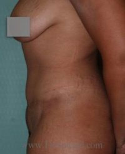 Tummy Tuck Before & After Gallery - Patient 206547 - Image 2