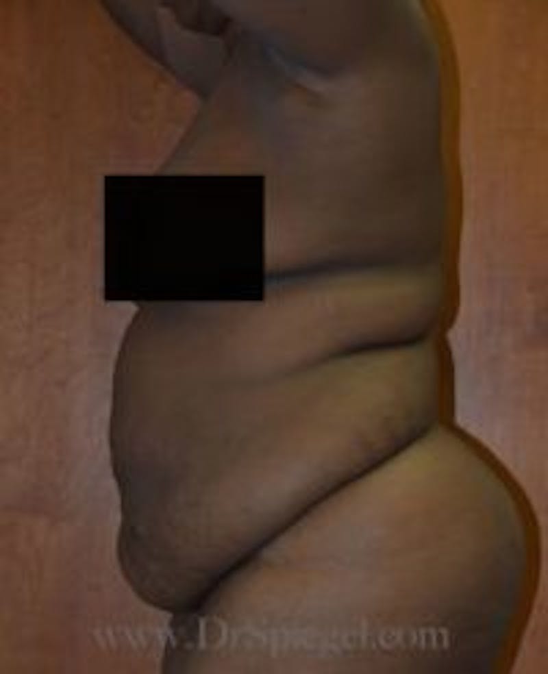 Mommy Makeover Before & After Gallery - Patient 394147 - Image 1