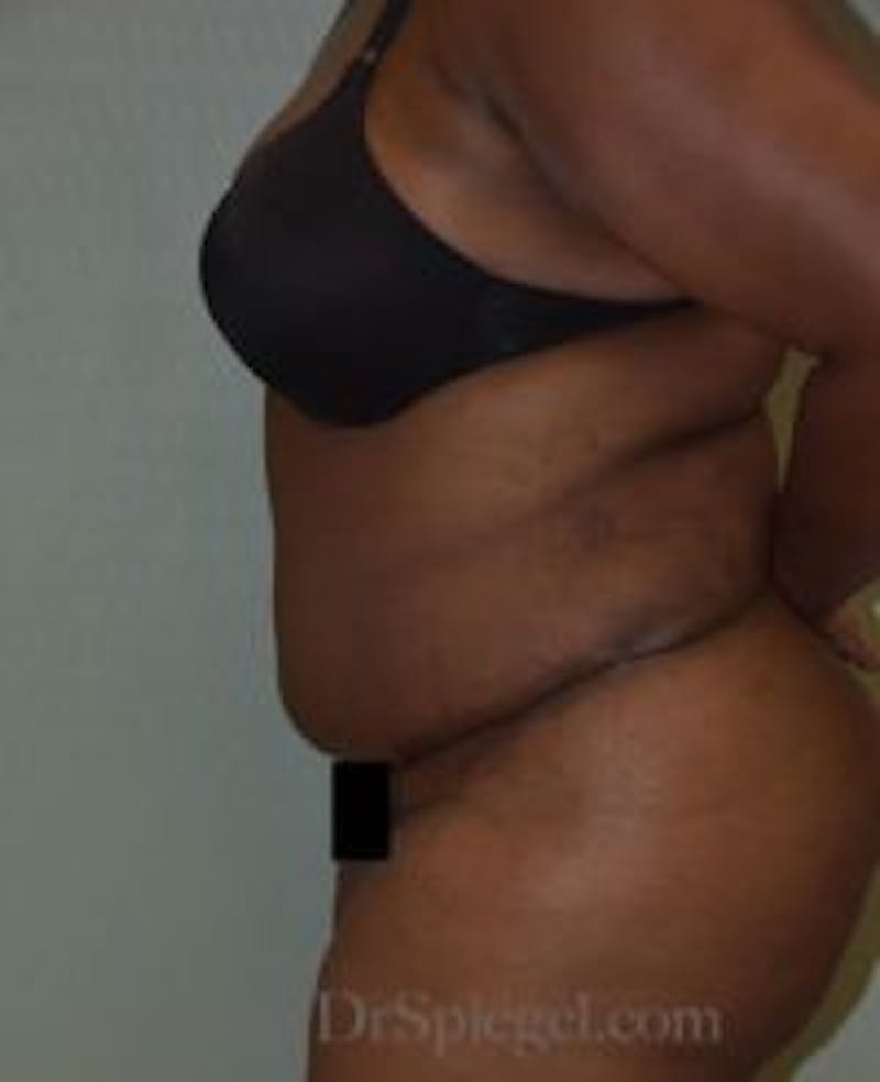 Mommy Makeover Before & After Gallery - Patient 394147 - Image 2