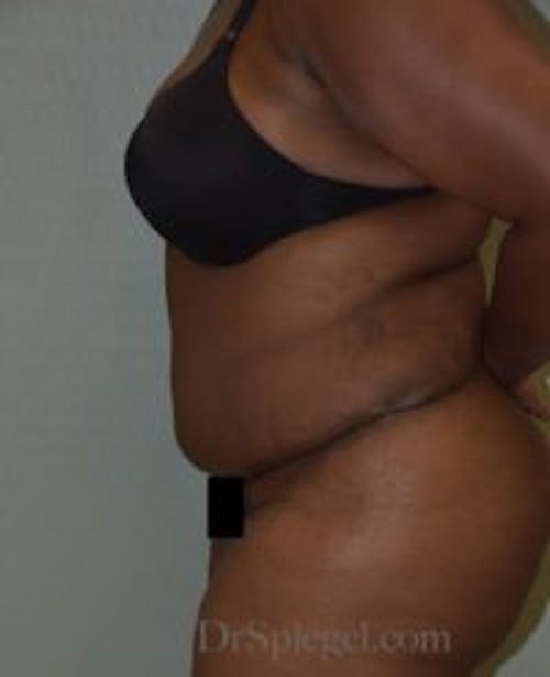 Mommy Makeover Before & After Gallery - Patient 394147 - Image 2