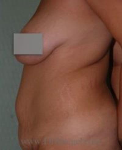Tummy Tuck Before & After Gallery - Patient 178521 - Image 1