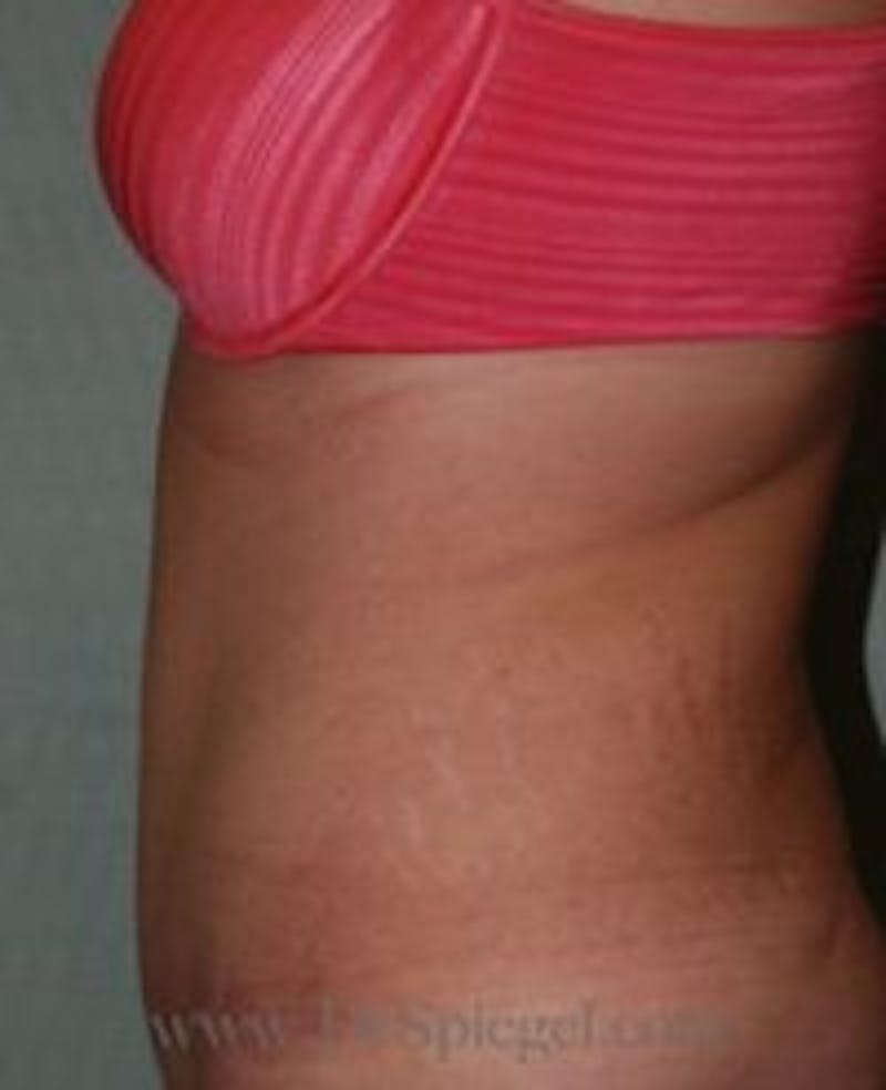 Mommy Makeover Before & After Gallery - Patient 266380 - Image 2