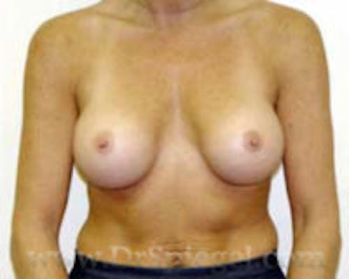 Mommy Makeover Before & After Gallery - Patient 366116 - Image 2