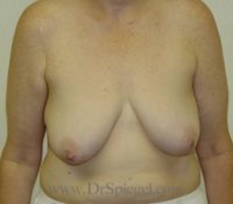 Mommy Makeover Before & After Gallery - Patient 369960 - Image 1
