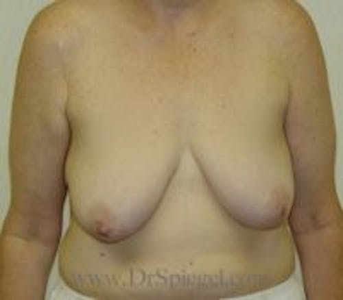 Mommy Makeover Before & After Gallery - Patient 369960 - Image 1