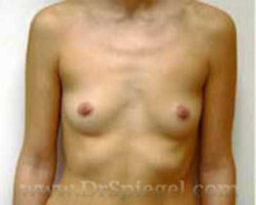 Mommy Makeover Before & After Gallery - Patient 716949 - Image 1