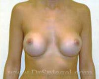 Mommy Makeover Before & After Gallery - Patient 716949 - Image 2
