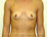 Mommy Makeover Before & After Gallery - Patient 195928 - Image 1