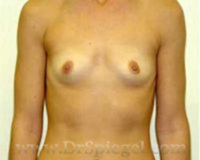 Mommy Makeover Before & After Gallery - Patient 195928 - Image 1