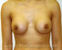 Mommy Makeover Before & After Gallery - Patient 155016 - Image 2