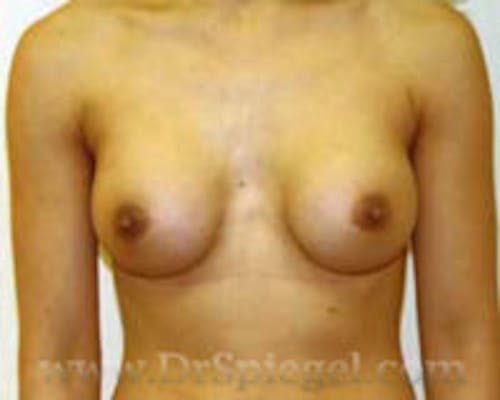 Mommy Makeover Before & After Gallery - Patient 155016 - Image 2