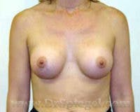Mommy Makeover Before & After Gallery - Patient 981401 - Image 2