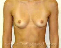 Mommy Makeover Before & After Gallery - Patient 116144 - Image 1