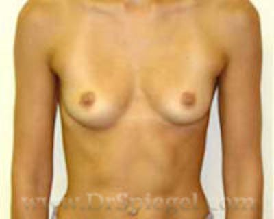 Mommy Makeover Before & After Gallery - Patient 116144 - Image 1