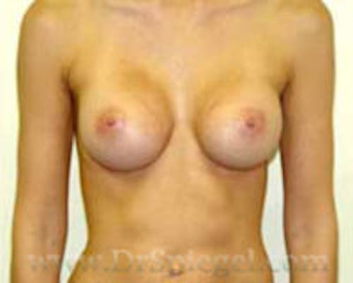 Mommy Makeover Before & After Gallery - Patient 116144 - Image 2