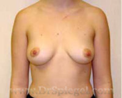 Mommy Makeover Before & After Gallery - Patient 318581 - Image 1