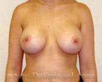 Mommy Makeover Before & After Gallery - Patient 318581 - Image 2