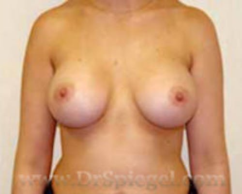 Mommy Makeover Before & After Gallery - Patient 318581 - Image 2