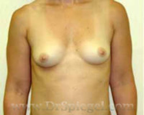 Mommy Makeover Before & After Gallery - Patient 265489 - Image 1
