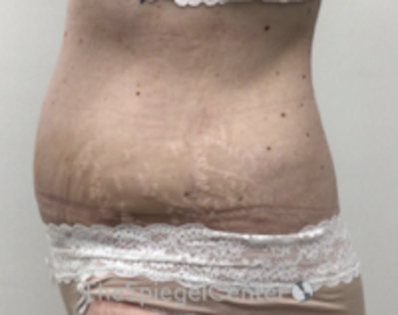 Tummy Tuck Before & After Gallery - Patient 298598 - Image 1