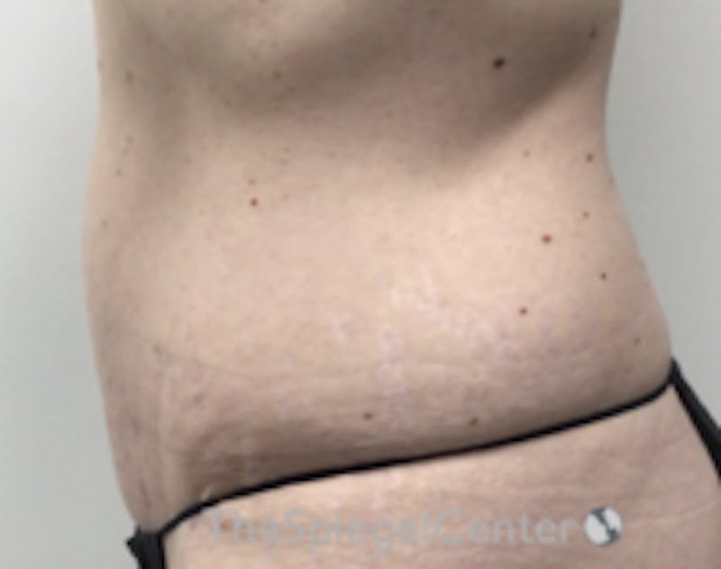 Tummy Tuck Before & After Gallery - Patient 298598 - Image 2