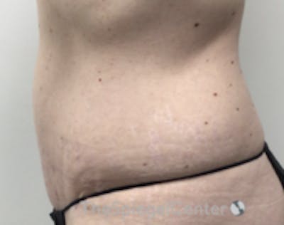 Tummy Tuck Before & After Gallery - Patient 298598 - Image 2