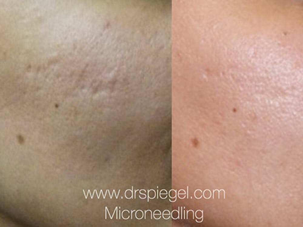 Microneedling BxA