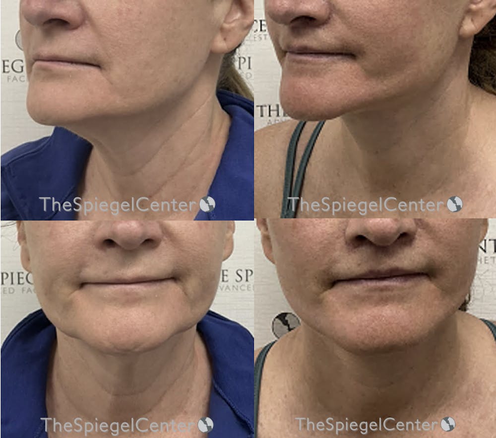 neck lift before and after