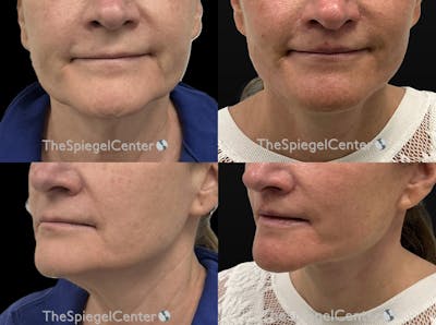 Facelift Before & After Gallery - Patient 304648 - Image 1