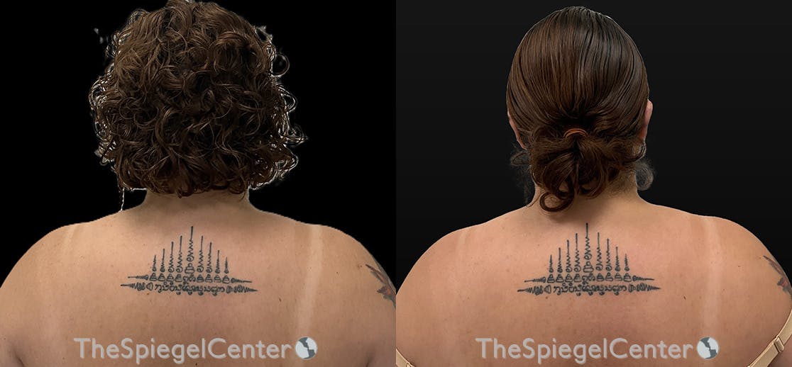 Trapezius Botox (TrapTox) Before & After Gallery - Patient 769081 - Image 1