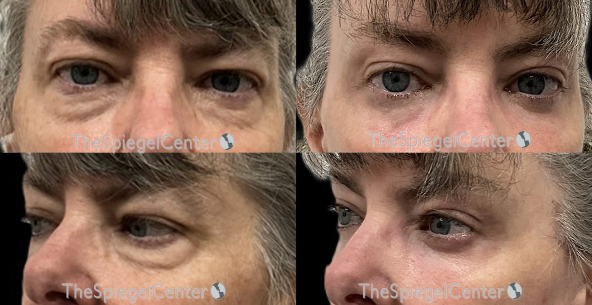 Blepharoplasty Before & After Gallery - Patient 340942 - Image 1
