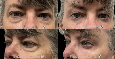 Blepharoplasty Before & After Gallery - Patient 340942 - Image 1
