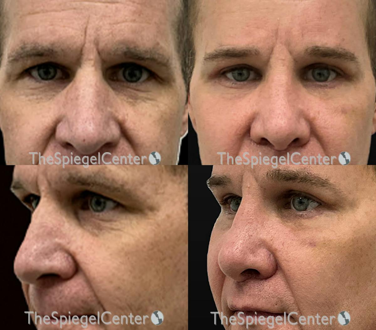 Revision Rhinoplasty Before & After Gallery - Patient 368374 - Image 1