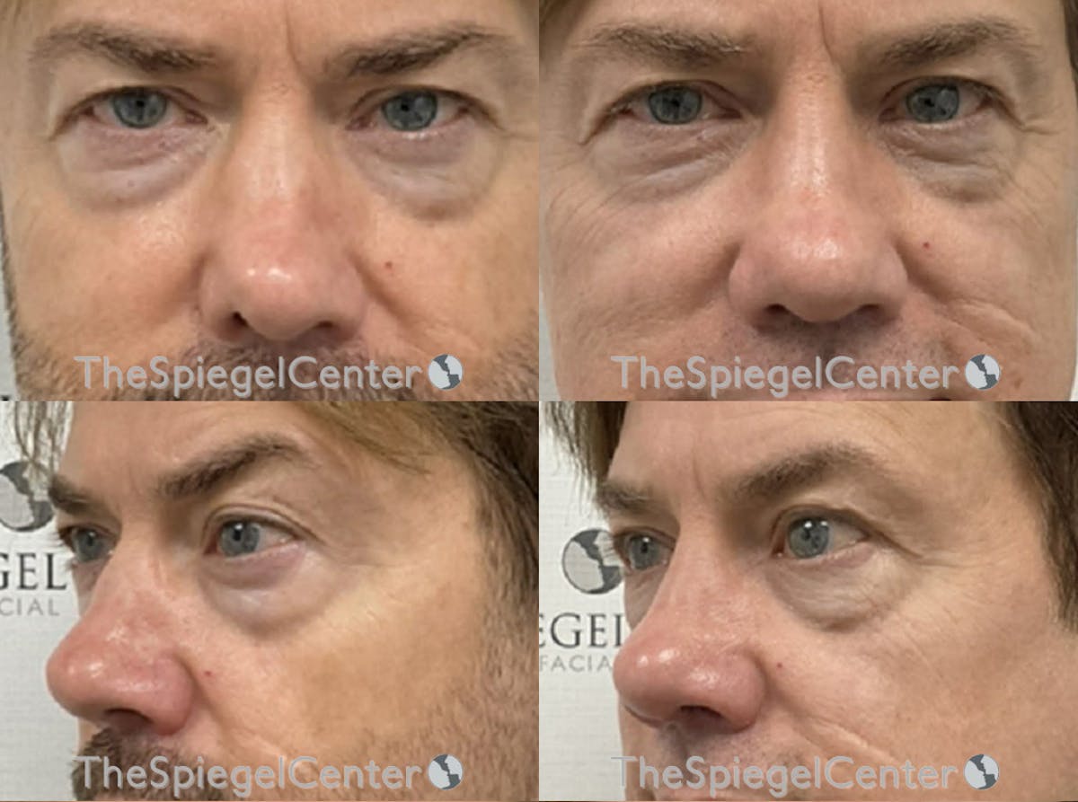 Revision Rhinoplasty Before & After Gallery - Patient 252563 - Image 1