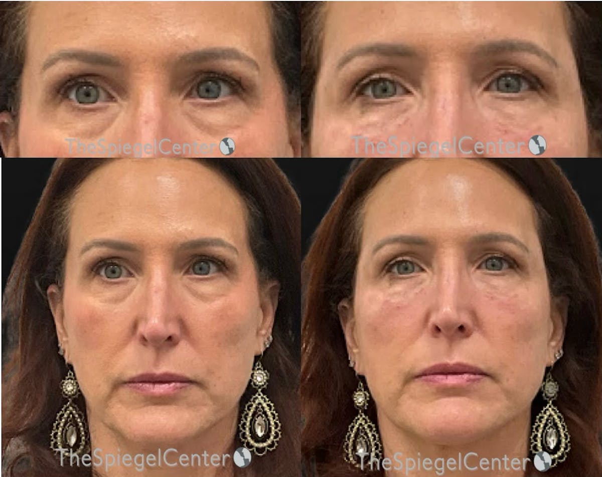 Temple Filler Before & After Gallery - Patient 105805 - Image 1