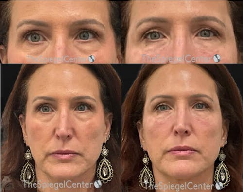Temple Filler Before & After Gallery - Patient 105805 - Image 1
