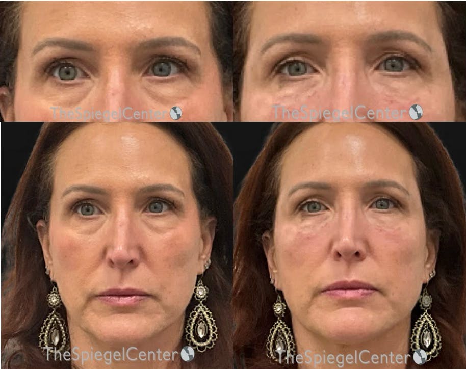 Temple Filler Before & After Gallery - Patient 105805 - Image 1