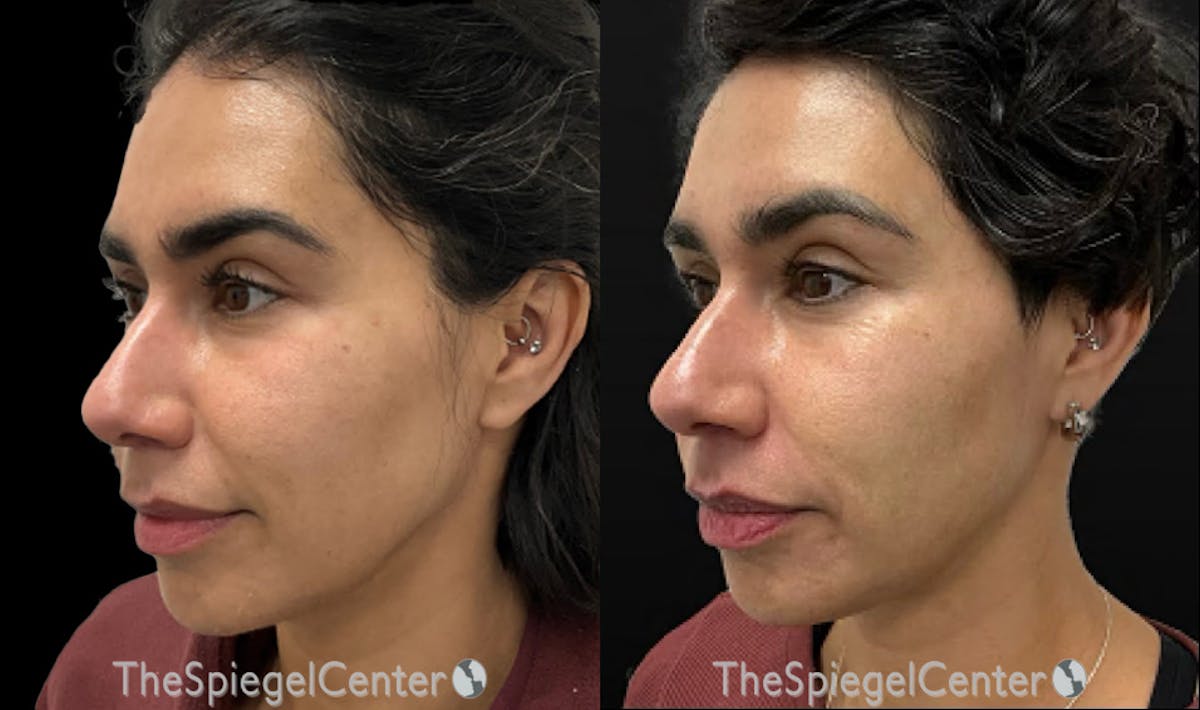IPL / Intense Pulse Light Before & After Gallery - Patient 253845 - Image 1