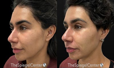 IPL / Intense Pulse Light Before & After Gallery - Patient 253845 - Image 1