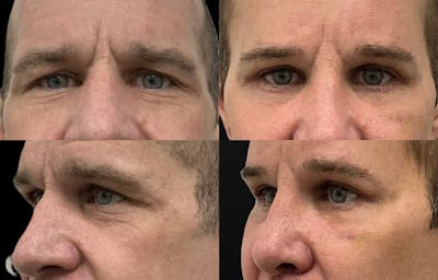 Blepharoplasty Before & After Gallery - Patient 162972 - Image 1