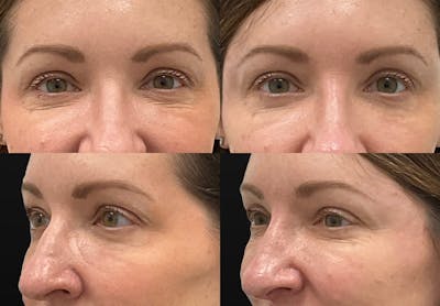 Tear Trough / Under Eye Fillers Before & After Gallery - Patient 341842 - Image 1