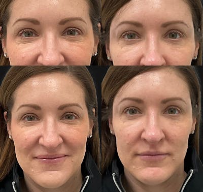 Temple Filler Before & After Gallery - Patient 413807 - Image 1