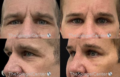 Blepharoplasty Before & After Gallery - Patient 162972 - Image 1